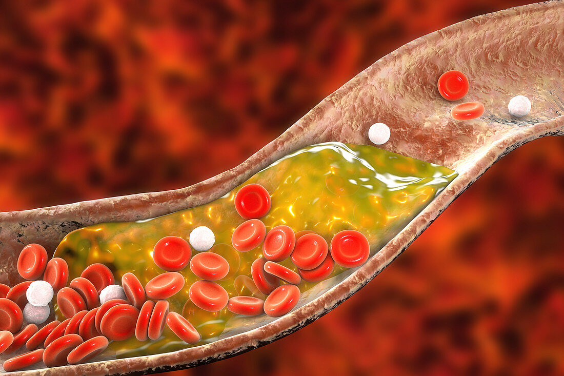 Atheromatous plaque in artery, illustration