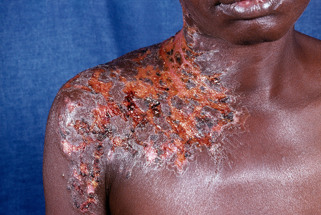 Shingles rash in an AIDS patient