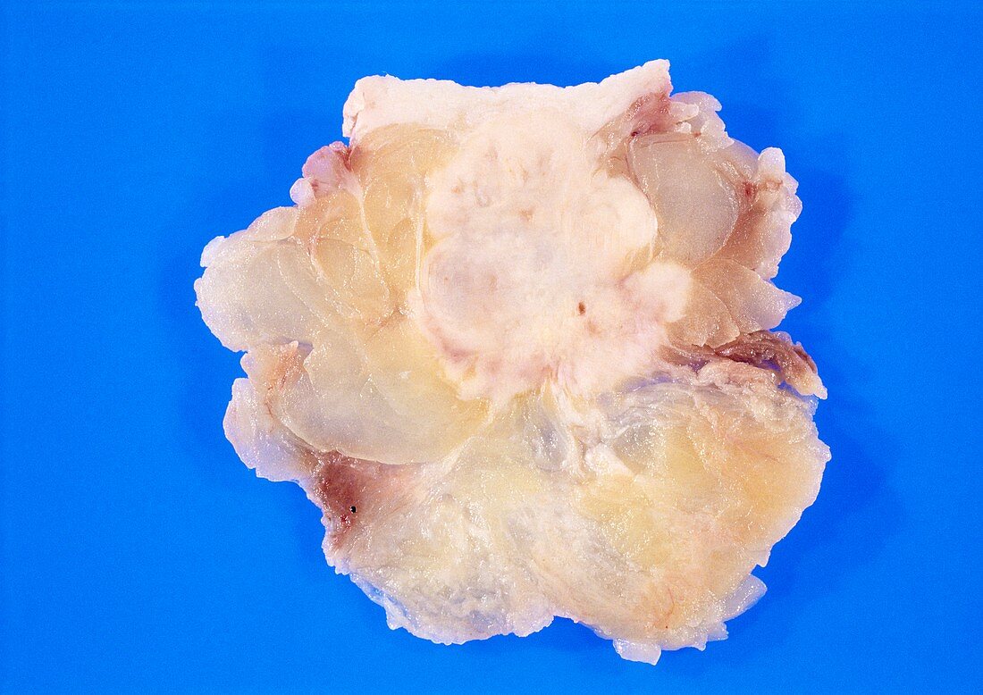 Gross specimen of excised breast carcinoma