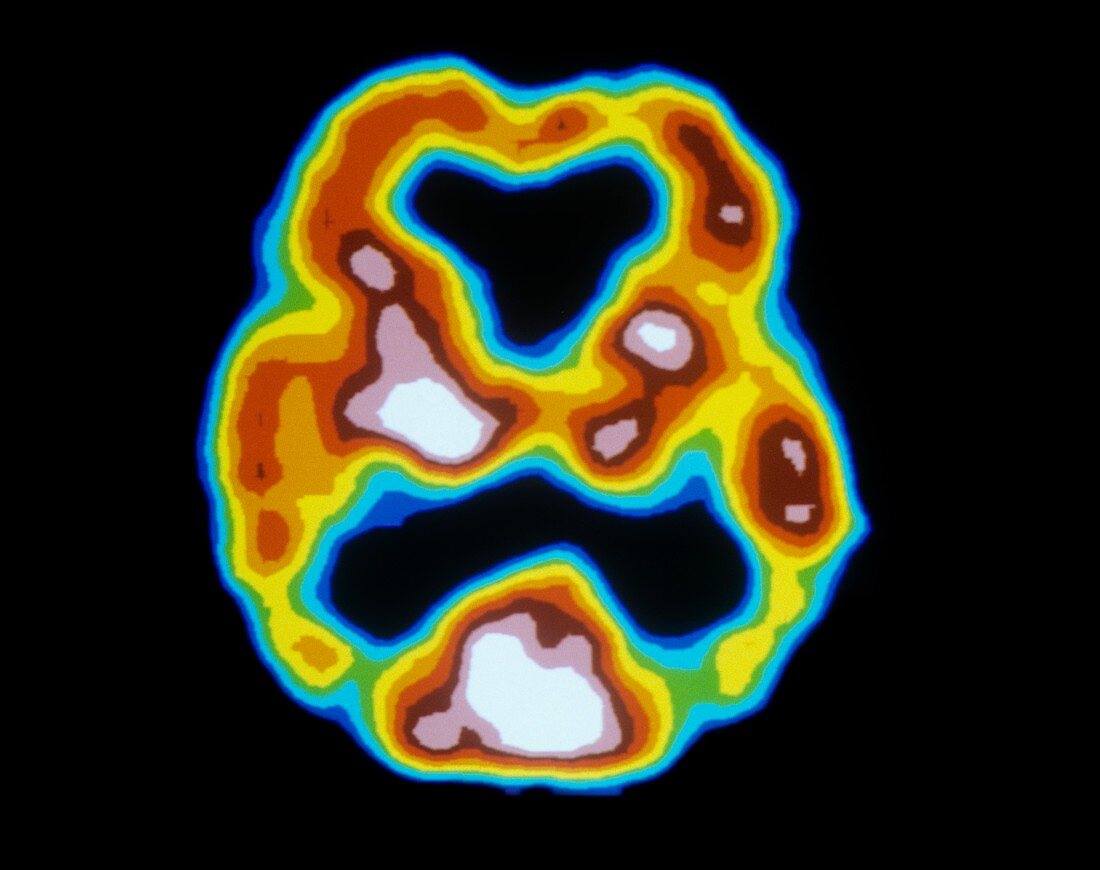Brain activity in Alzheimer's, SPECT scan