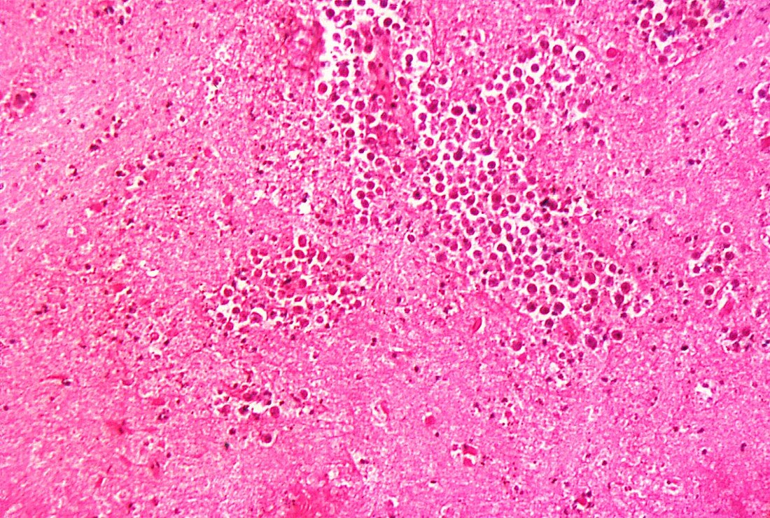 Naegleria fowleri amoeba infection, light micrograph