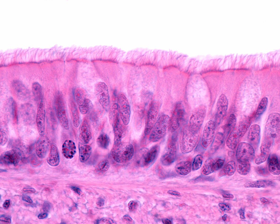 Papilloma of the larynx, light micrograph