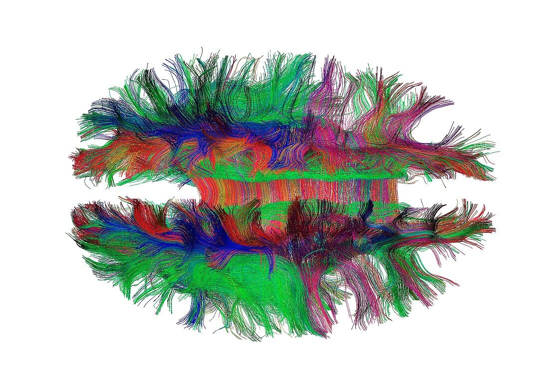 Brain fibres top view, DTI scan
