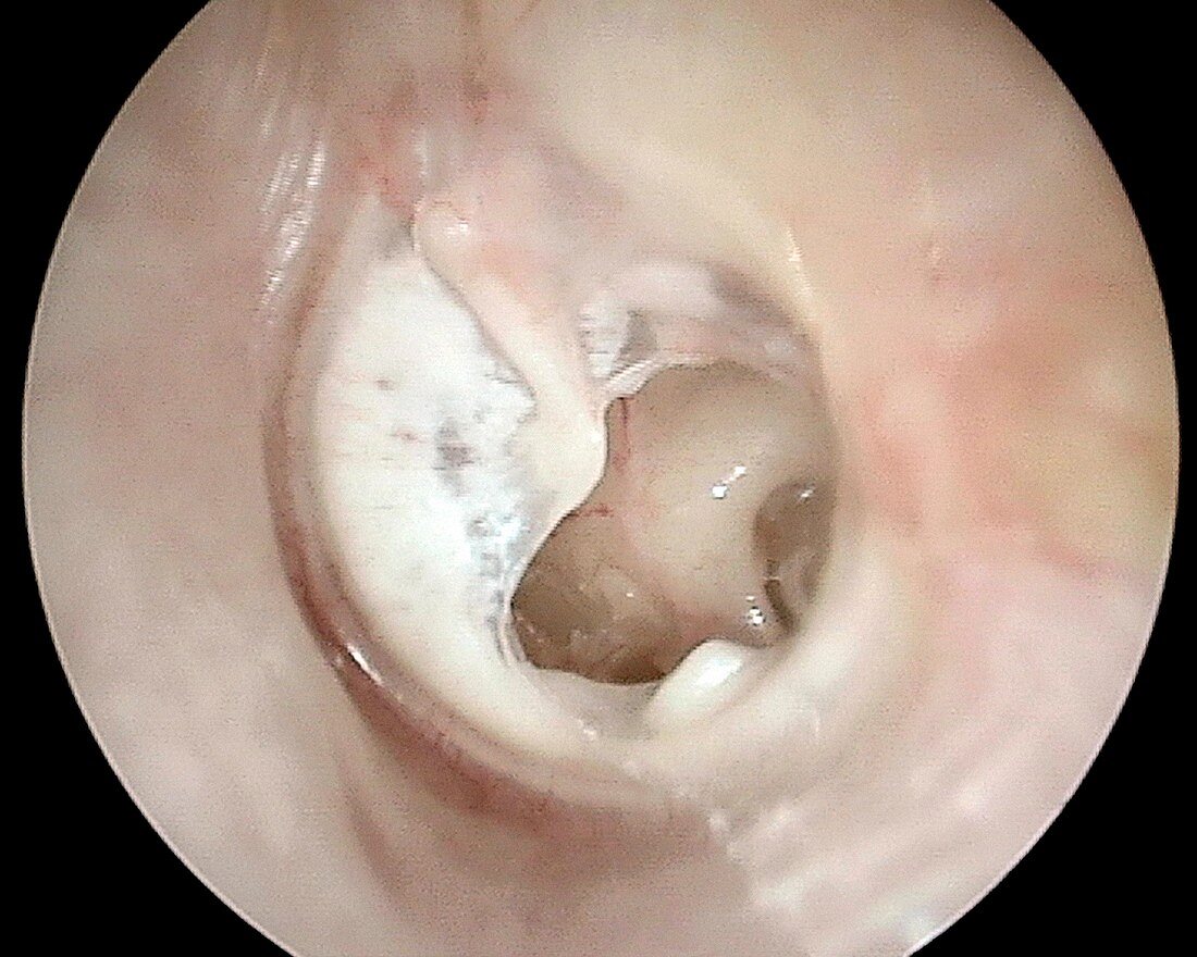 Tympanosclerosis, otoscope view