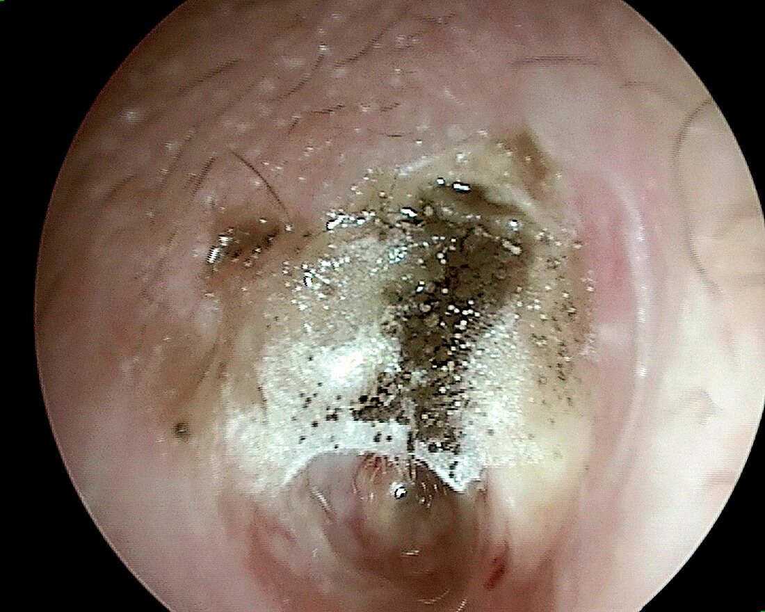 Fungal middle ear infection, otoscope view