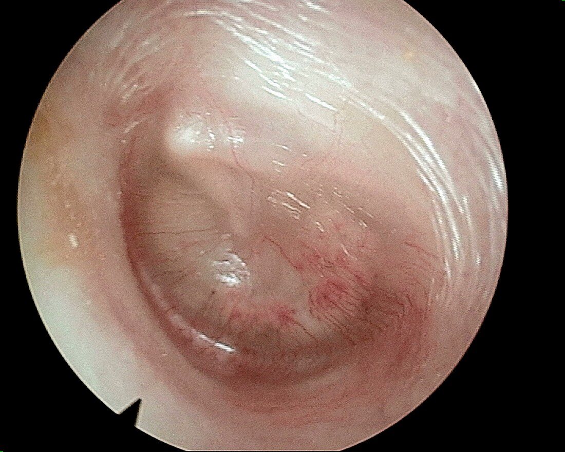 Glue ear, otoscope view