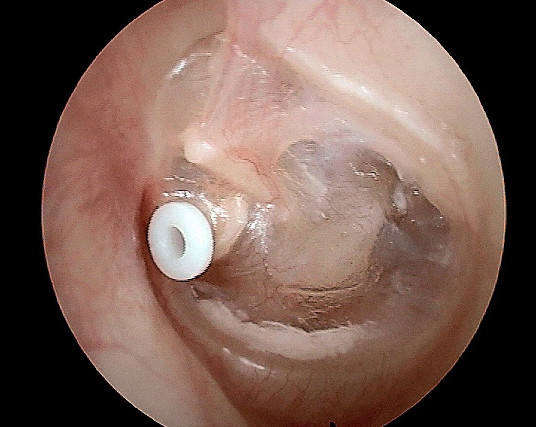 Grommet in the eardrum, otoscope view
