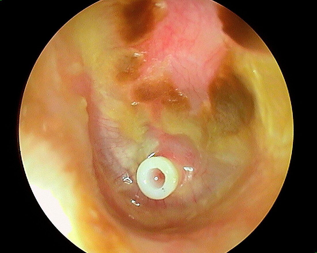 Discharge from eardrum with grommet, otoscope view