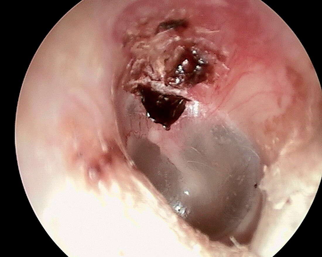 Cholesteatoma of the eardrum, otoscope view