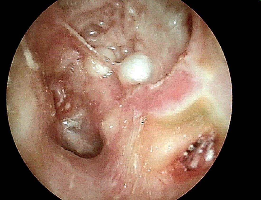 Mastoid cavity and cholesteatoma, otoscope view