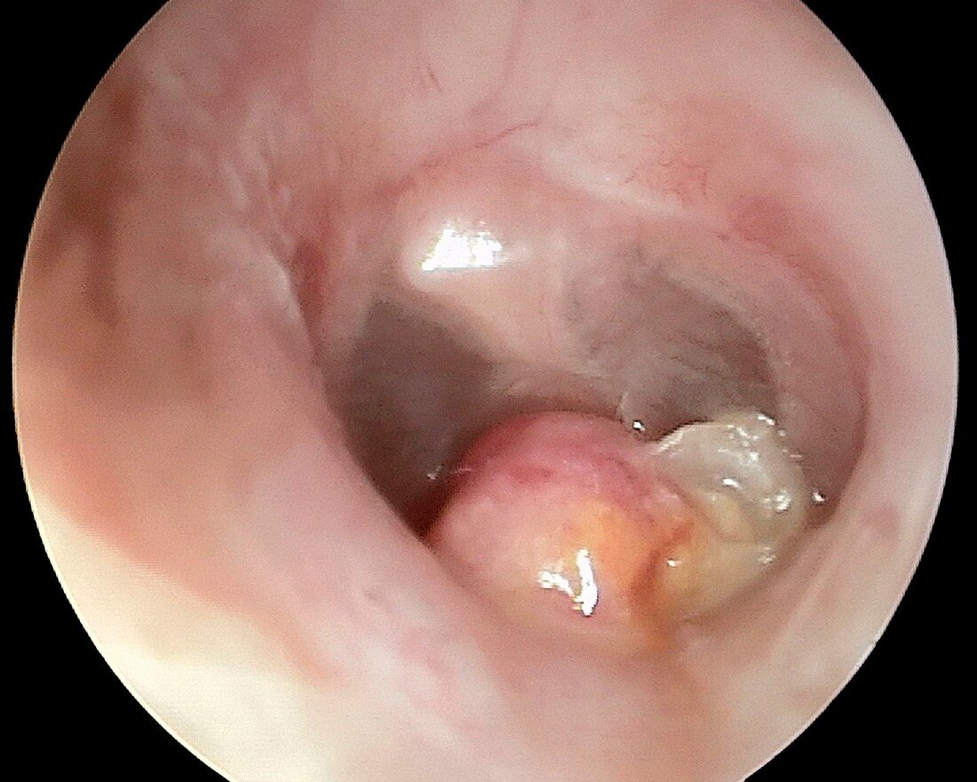 Aural polyp, otoscope view