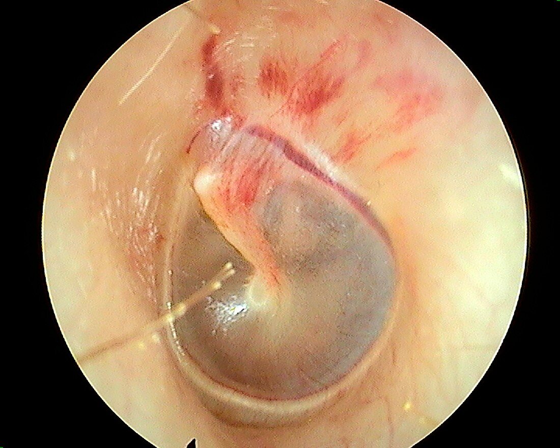 Barotrauma inside the ear, otoscope view