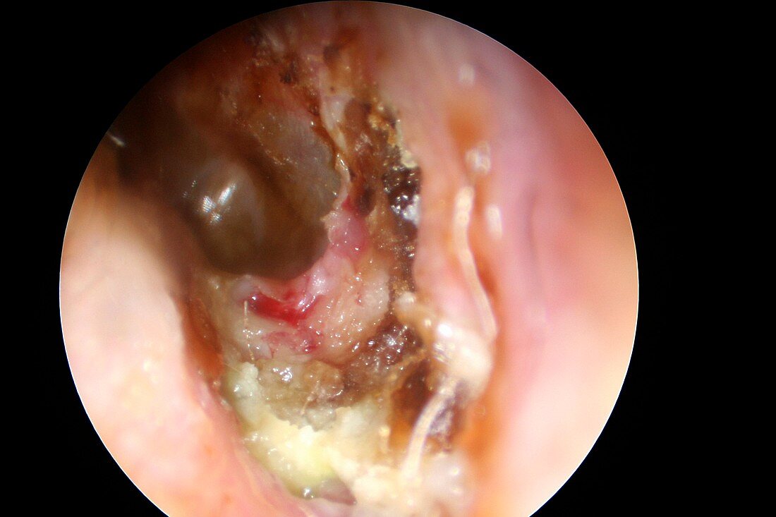 Cholesteatoma of the ear canal, otoscope view