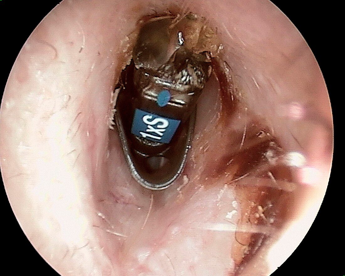 Foreign body in the ear canal, otoscope view