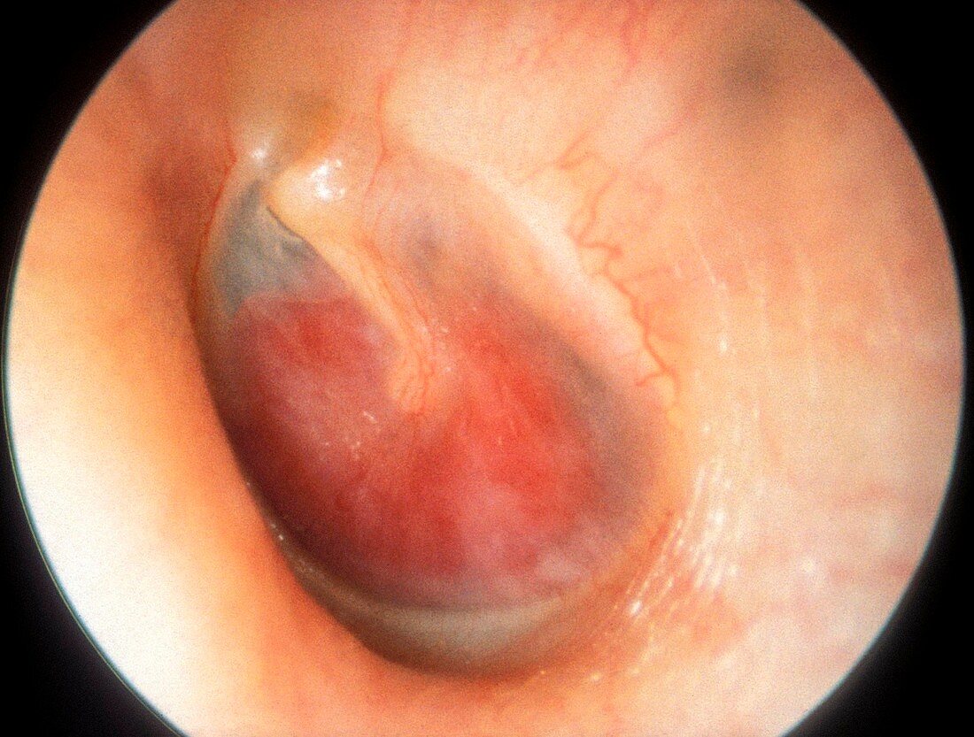 Glomus tumour, otoscope view