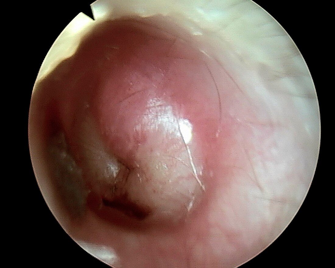 Acute bacterial otitis, otoscope view
