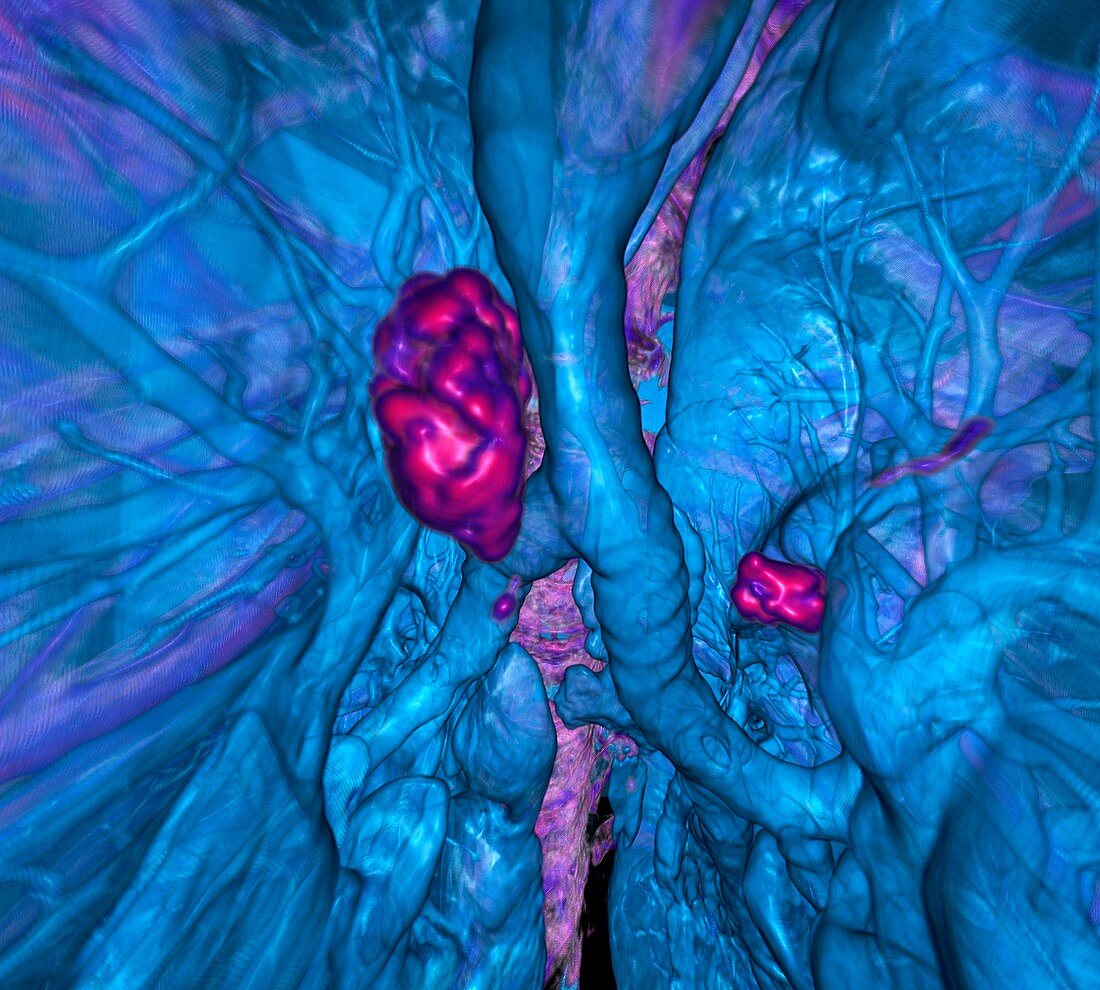 Calcified lung lymph nodes, 3D CT scan