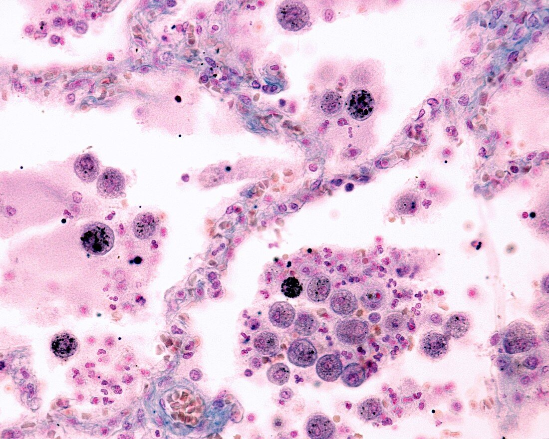 Pneumonia, light micrograph