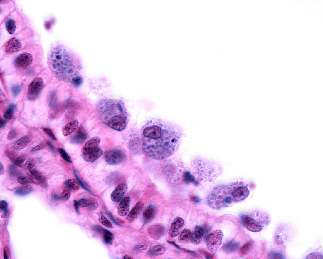 Macrophages in bronchiole, light micrograph