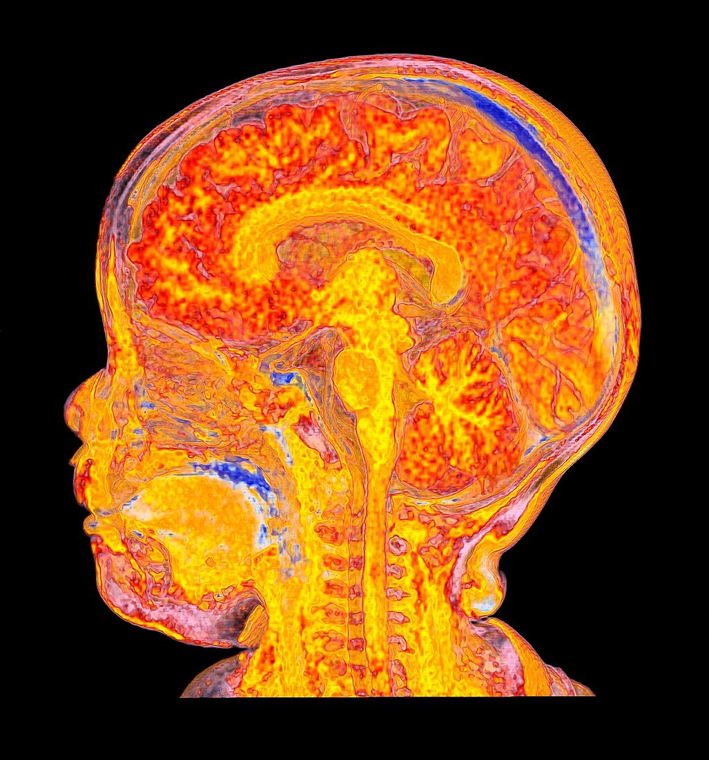 Child's head and brain, sagittal MRI scan
