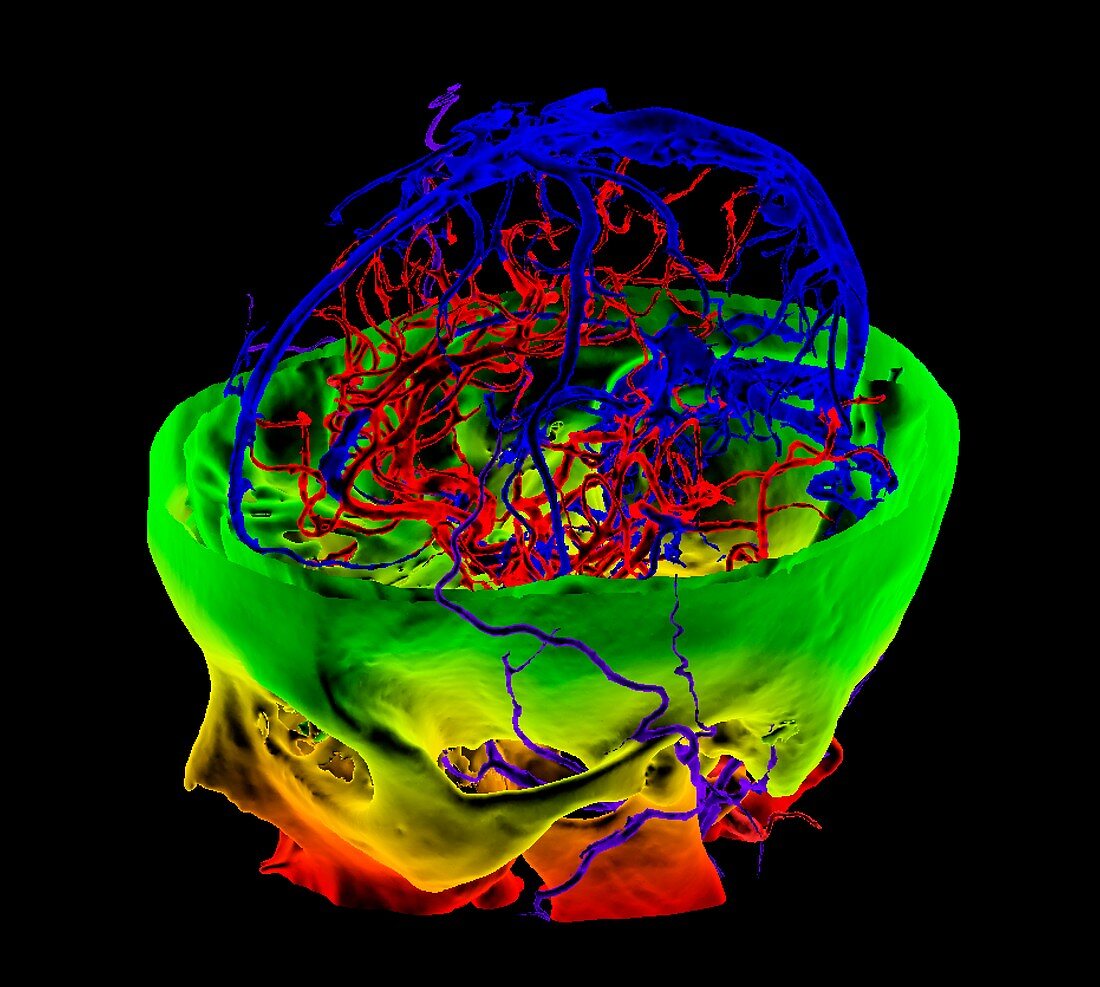 Brain blood vessels, 3D CT angiogram