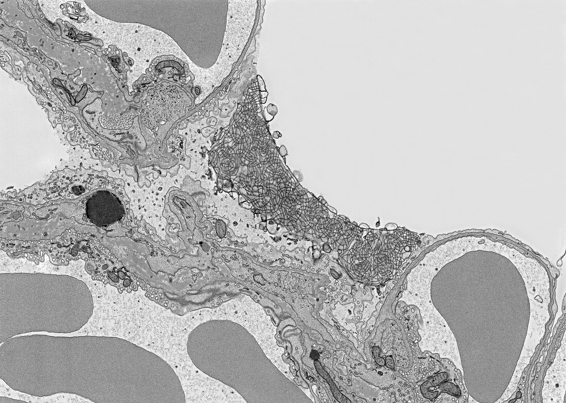 Tubular myelin in alveolar lung fluid, TEM