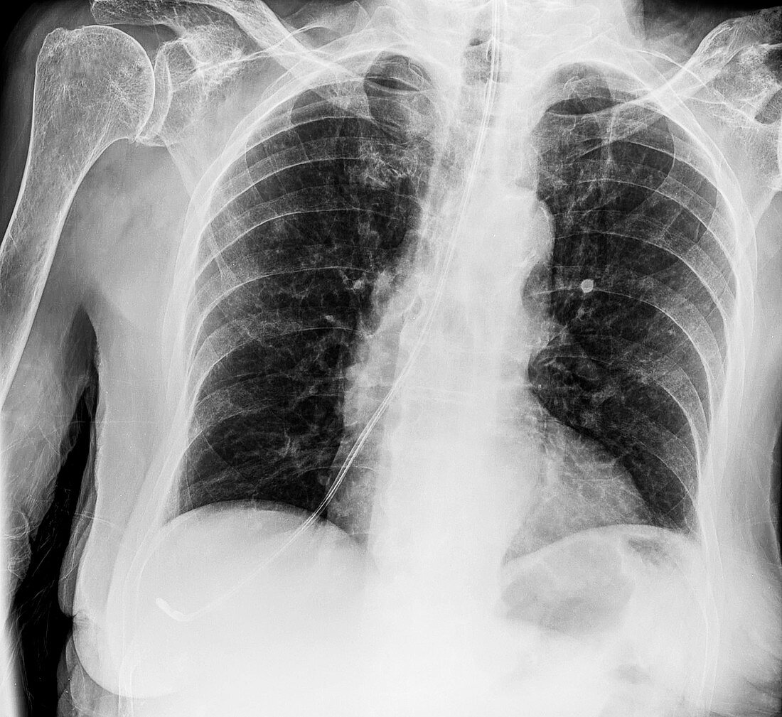 Incorrectly positioned nasogastric tube, X-ray