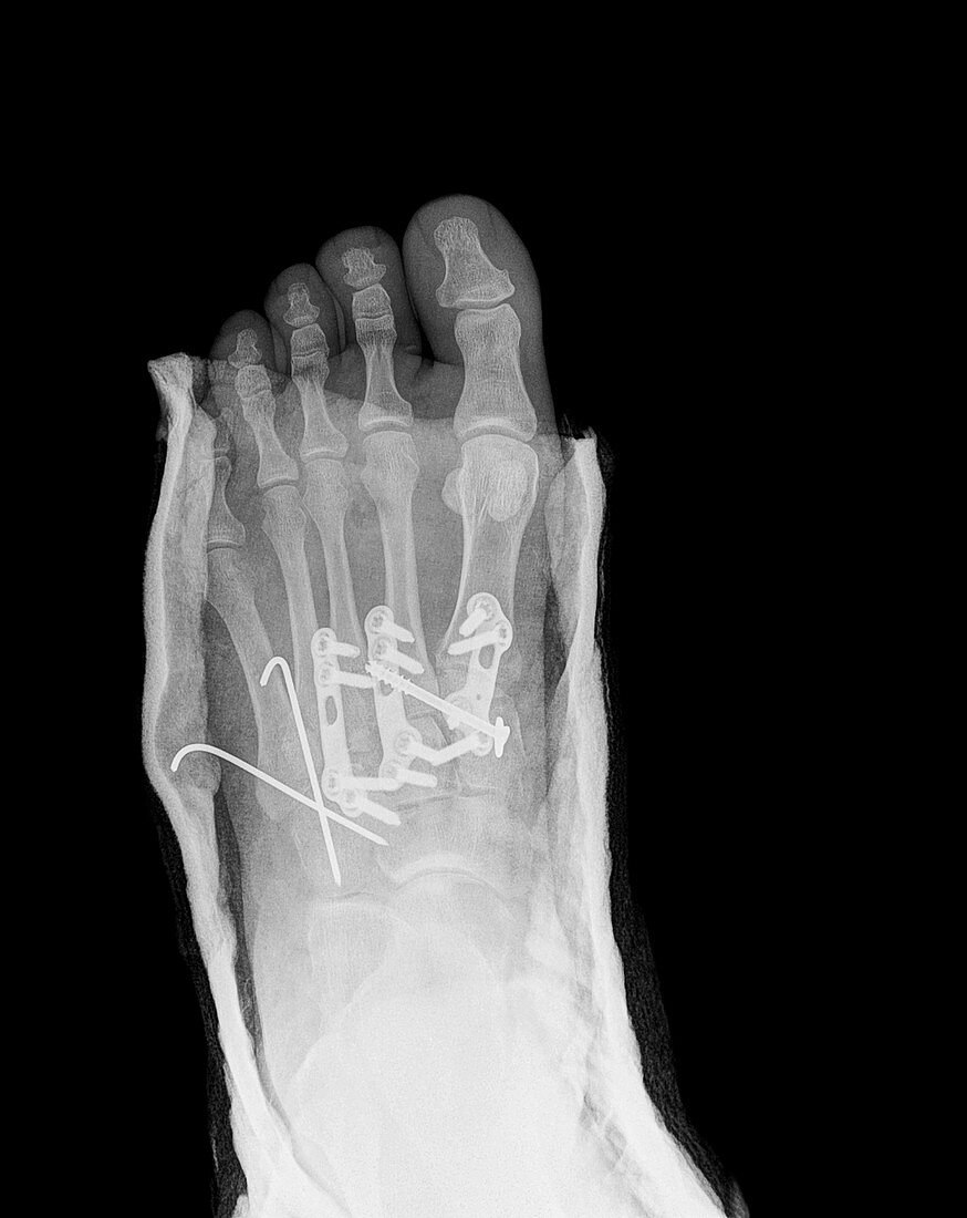 Pinned fractured metatarsal foot bones, X-ray