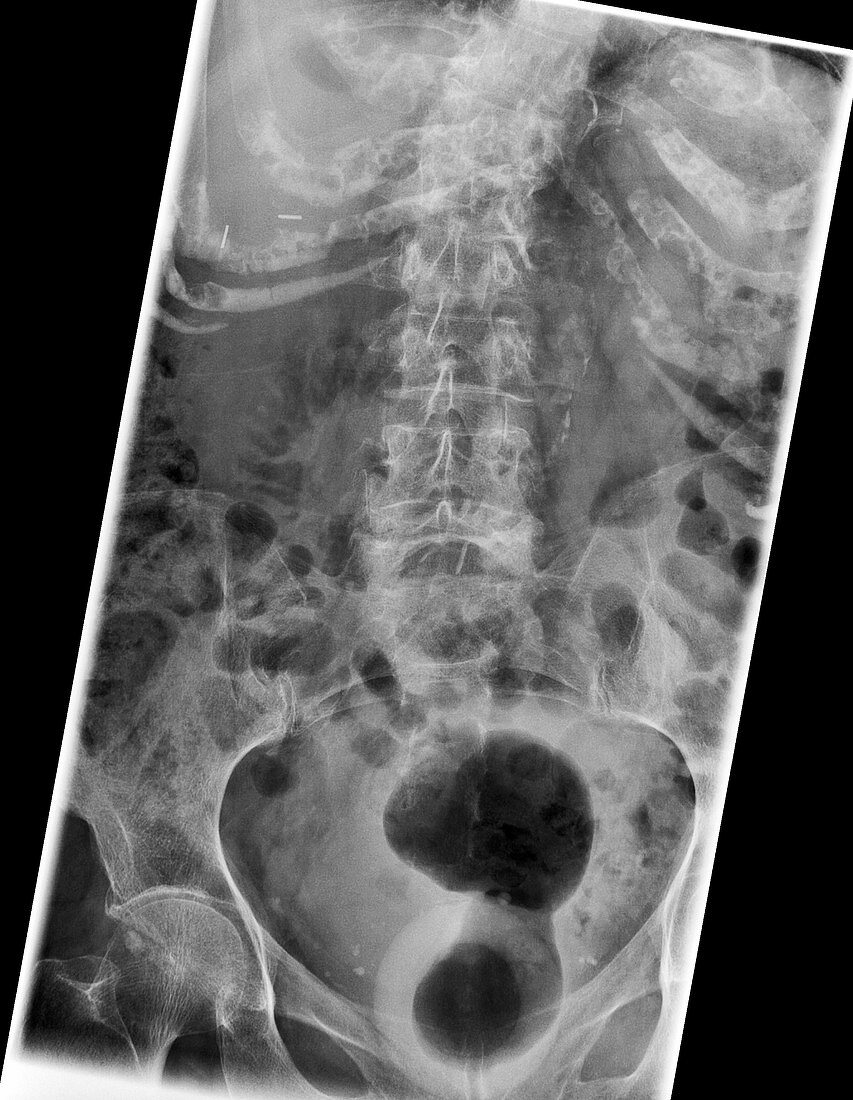 Lumbar vertebral collapse, X-ray