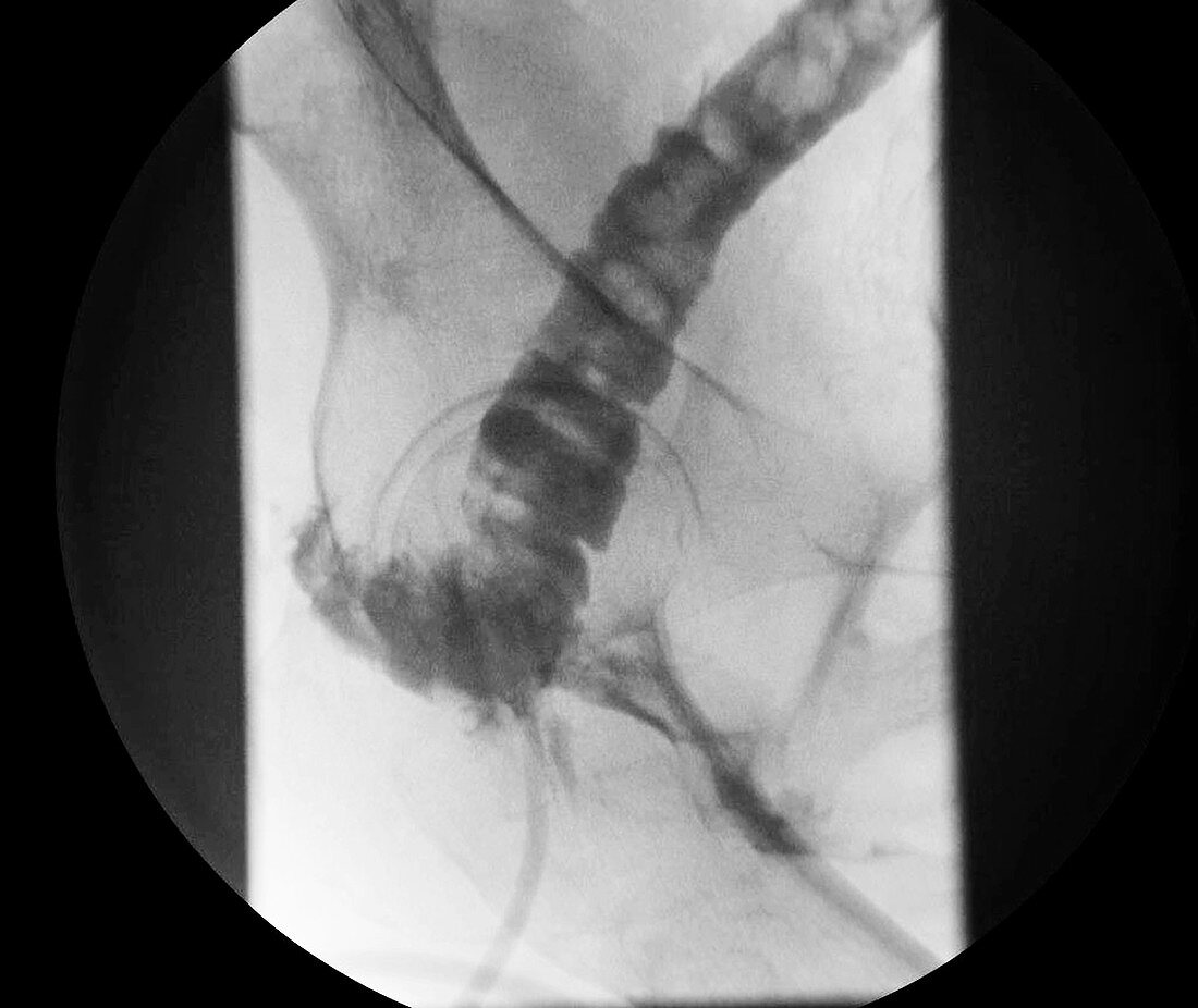 Rectovaginal fistula, X-ray