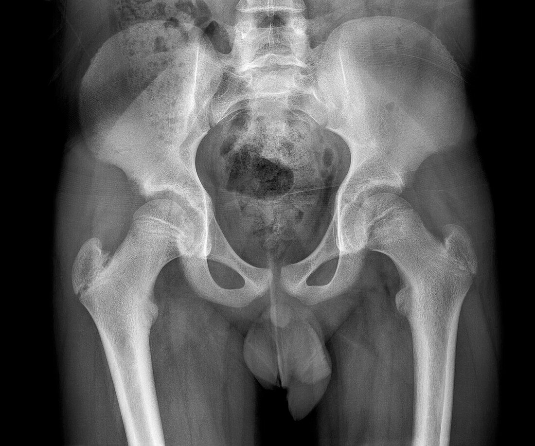 Slipped capital femoral epiphysis, X-ray