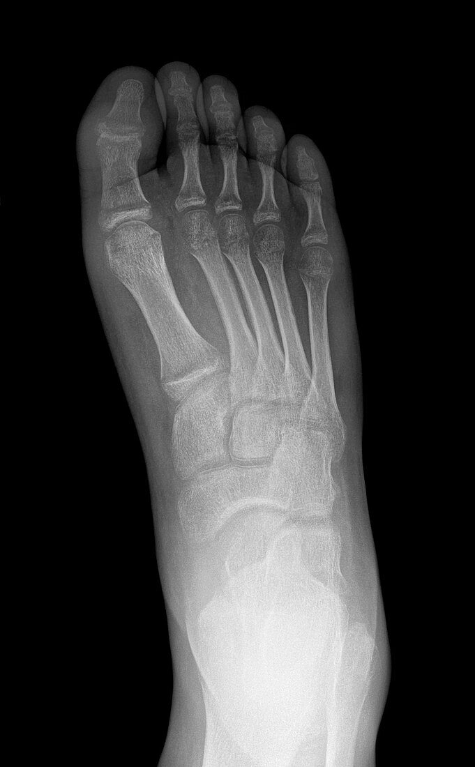 Demineralisation of foot bones, X-ray