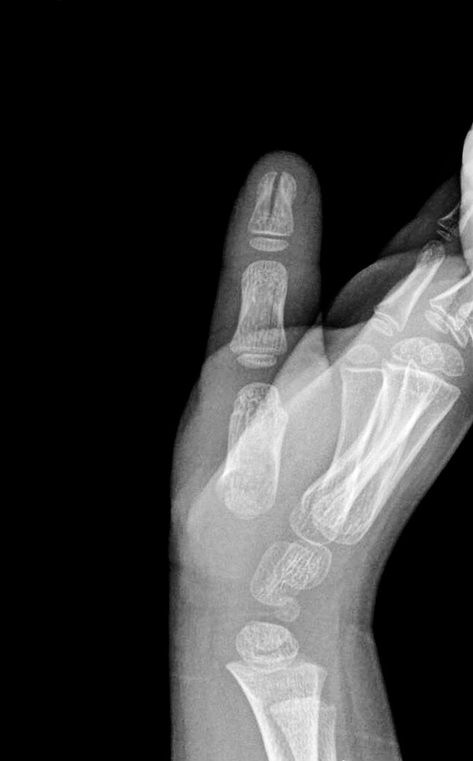 Fractured thumb bone, X-ray