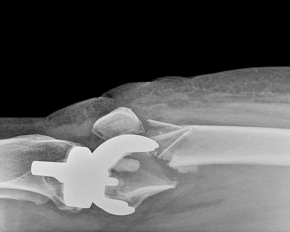 Fractured knee bones and implant, X-ray