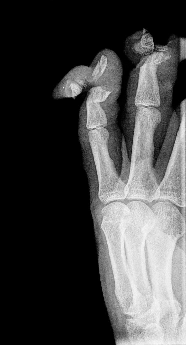 Lawnmower finger injuries, X-ray