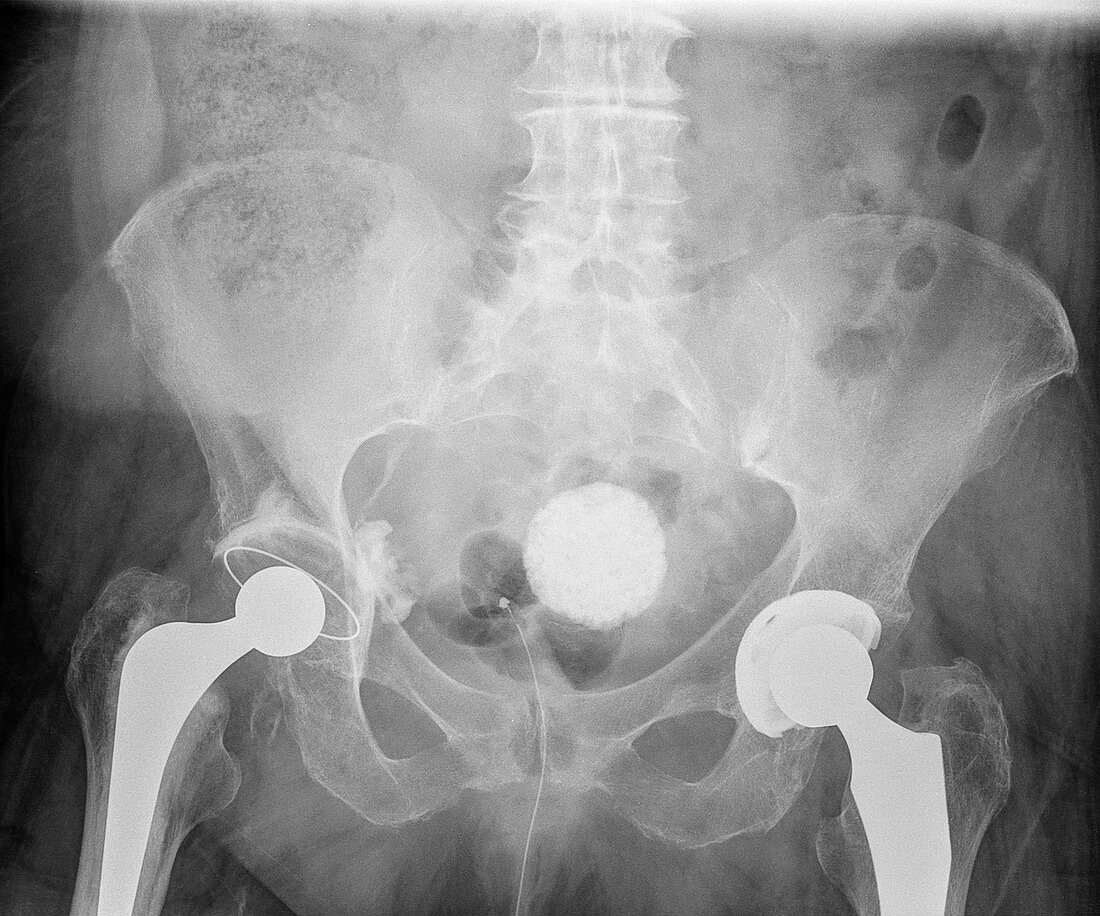 Calcified uterine fibroid, X-ray