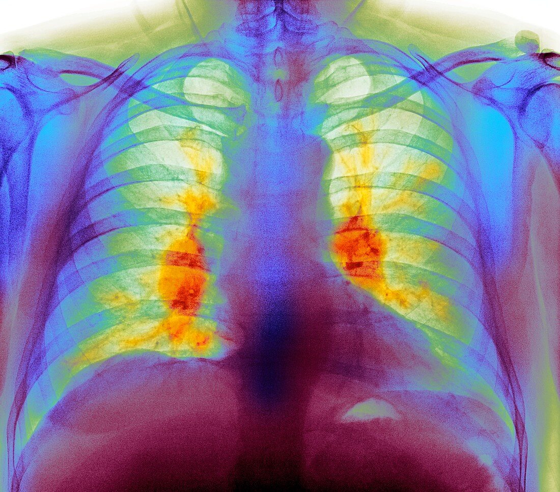 Sarcoidosis of the lungs, X-ray