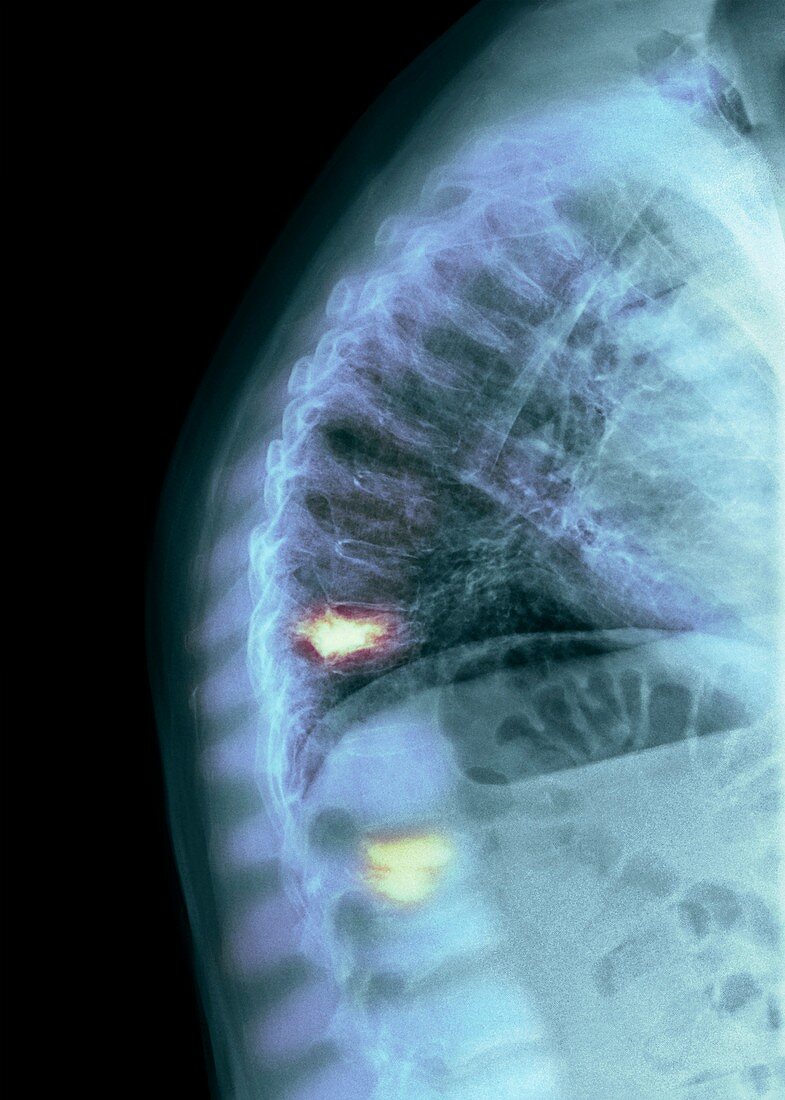 Osteoporosis of the spine with vertebroplasty, X-ray