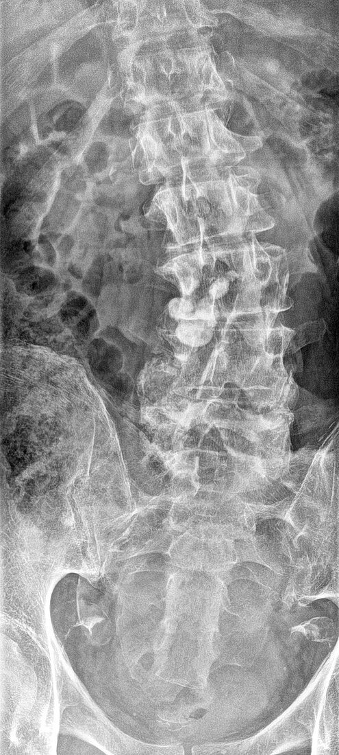Kyphoscoliosis, X-ray