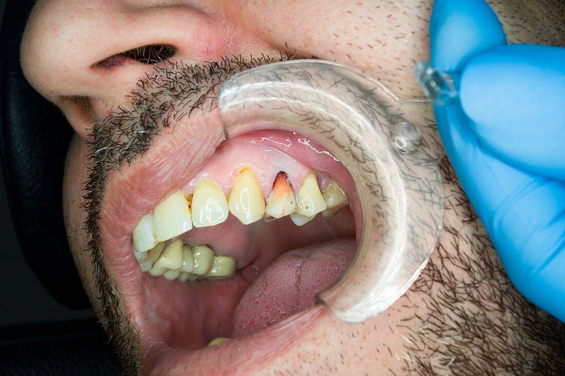 Discoloured premolar before cosmetic restoration