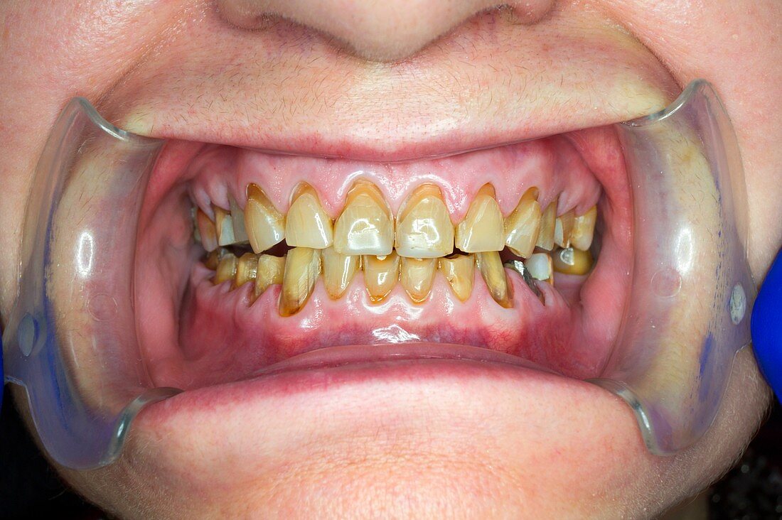 Teeth before dental crown surgery