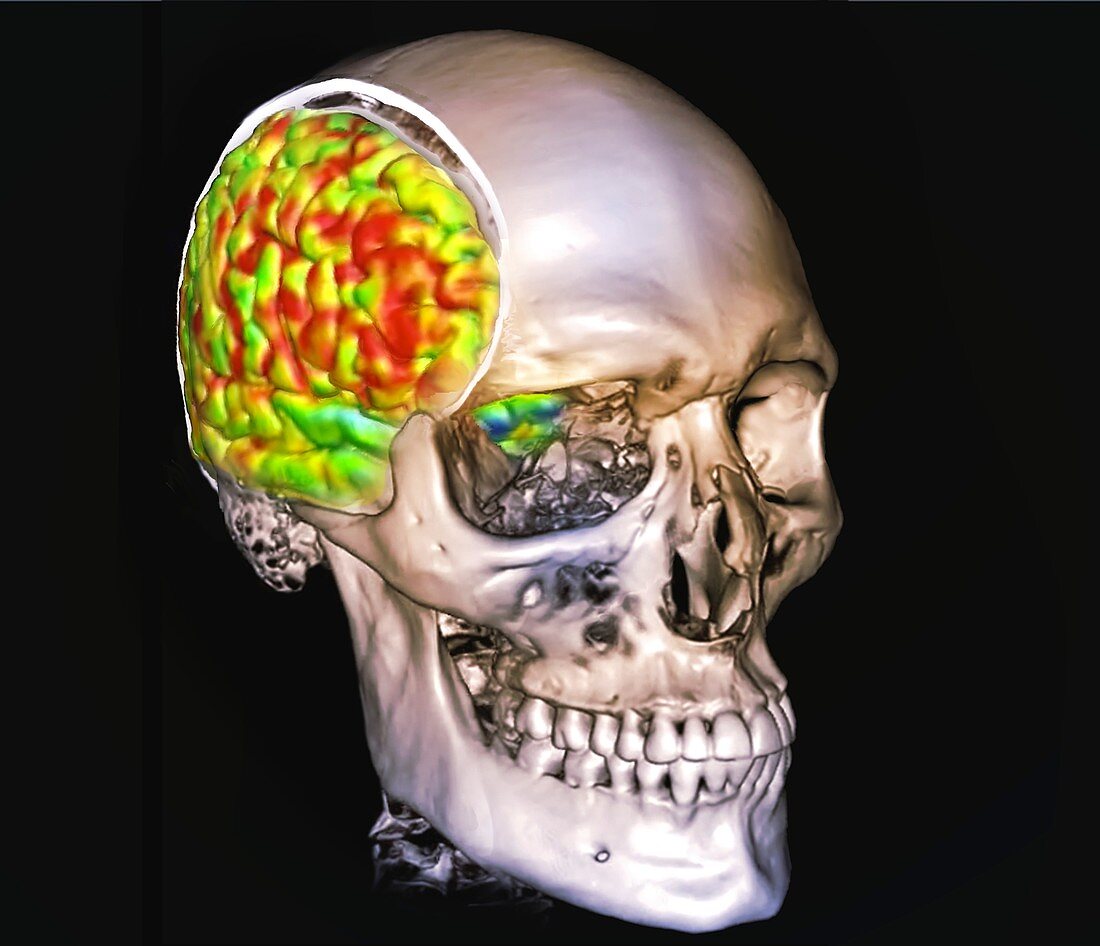 Human brain's right hemisphere, fMRI scan