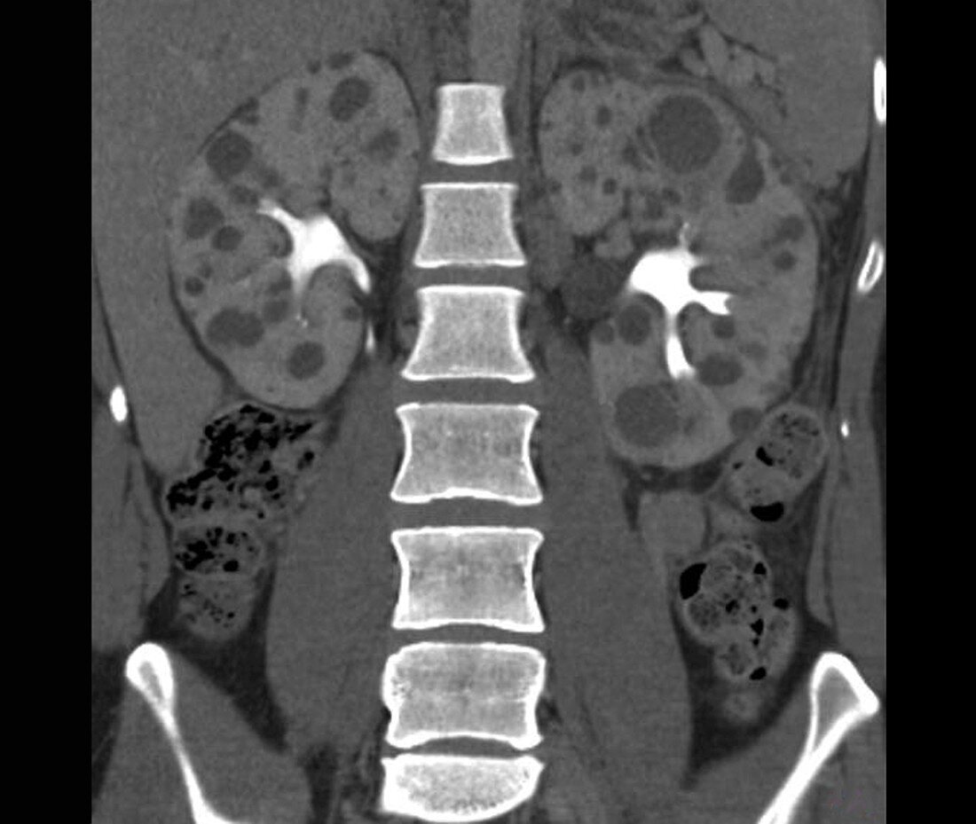 Polycystic kidneys, CT scan