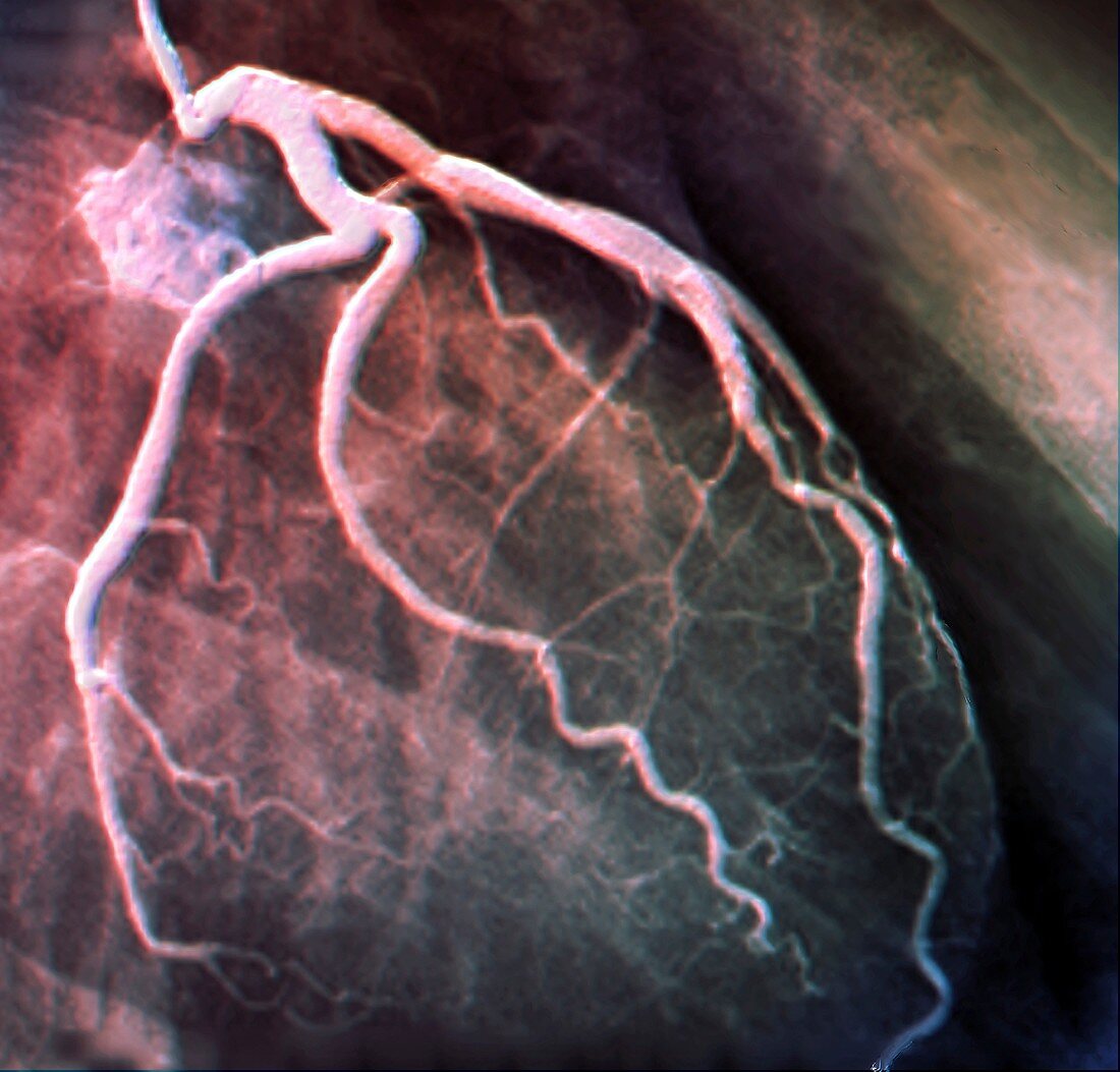 Left coronary artery, coronarography scan