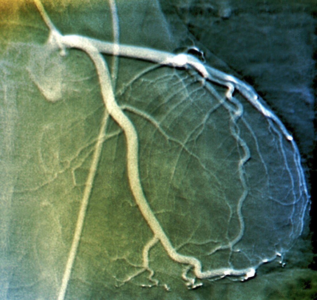 Left coronary artery, coronarography scan
