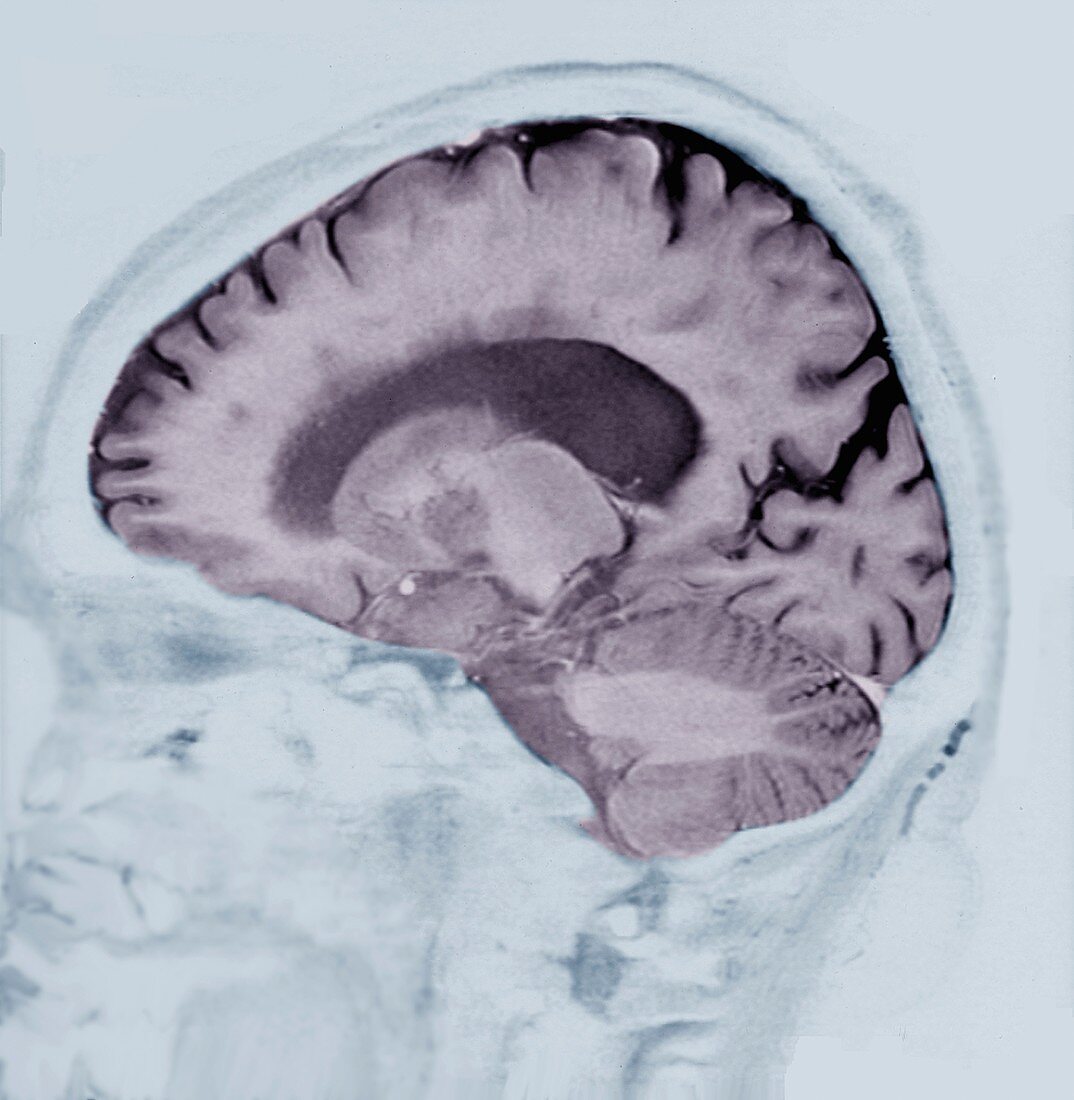 Alzheimer's disease, MRI brain scan