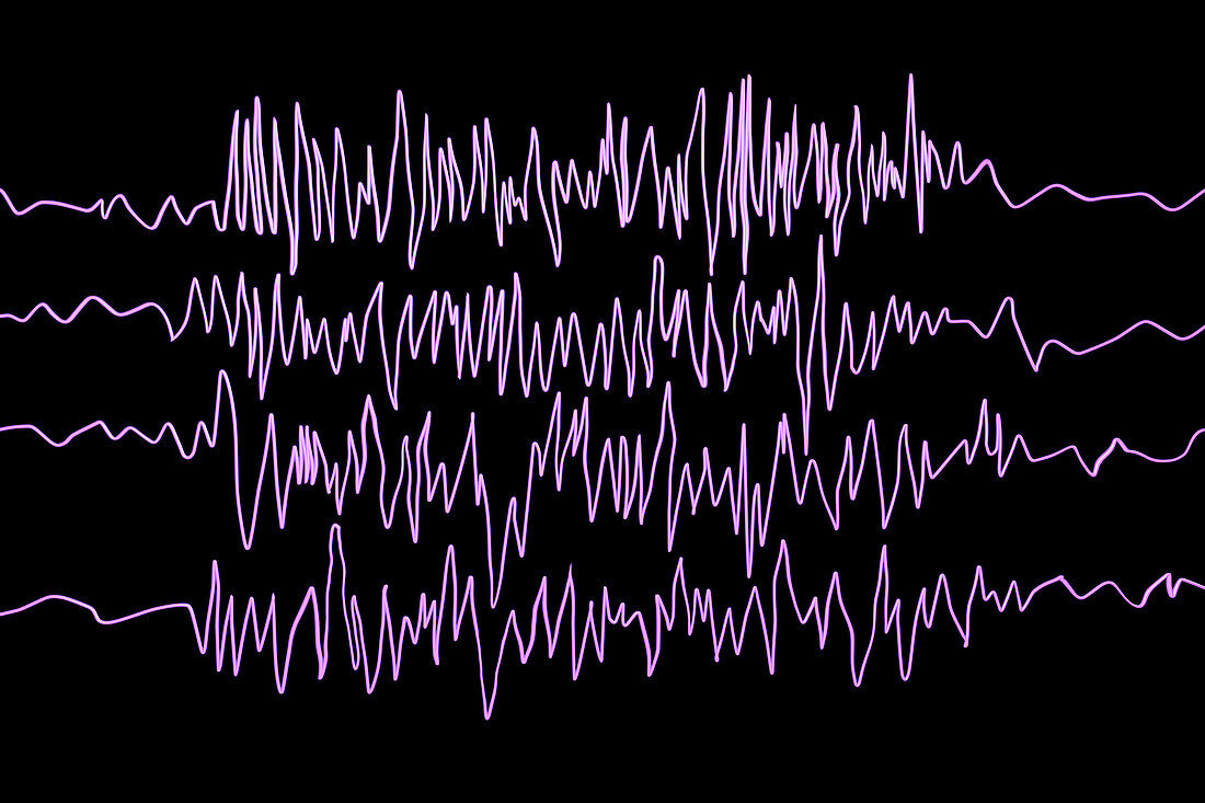 Brain waves in epilepsy, illustration
