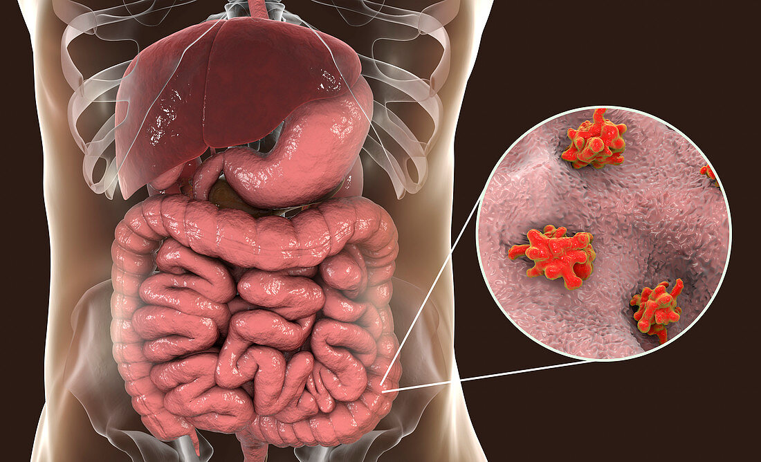 Parasitic amoeba in large intestine, illustration