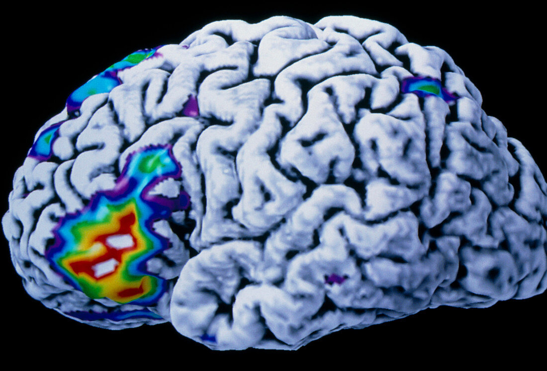 Coloured PET brain scan during a speech exercise