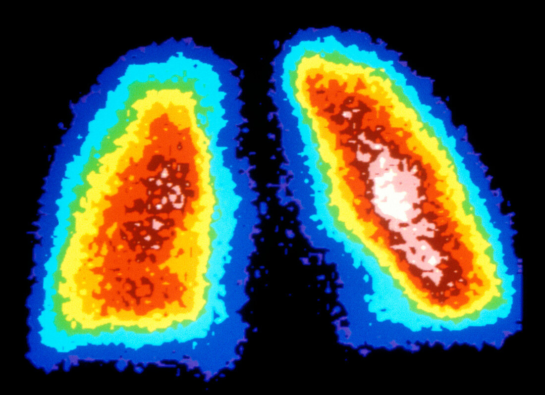 Gamma ray scan of healthy human lungs